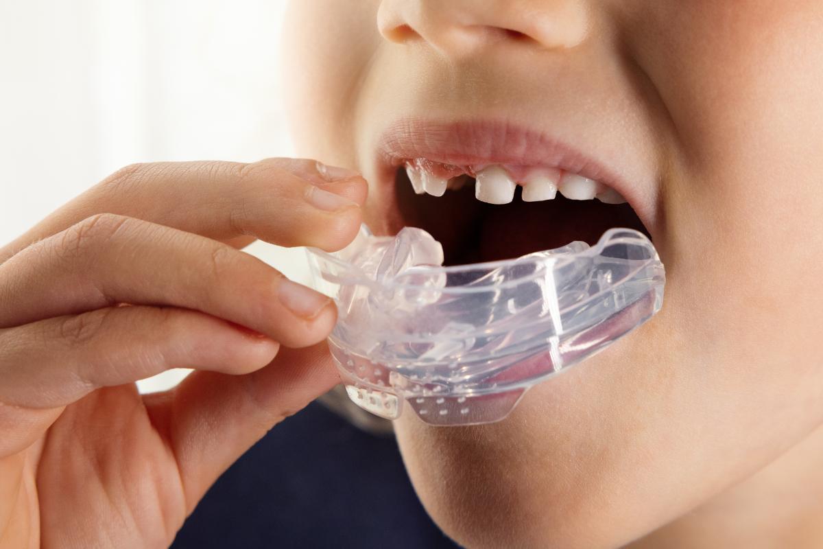 Sports Guard (Custom Mouthguard for Athletes)For Children In Chennai Sports Guard (Custom Mouthguard for Athletes)For Children In Chennai