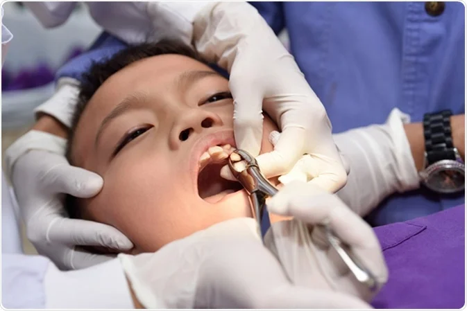 Tooth Extraction-Children dental Care Treatments Tooth Extraction For Children In Chennai