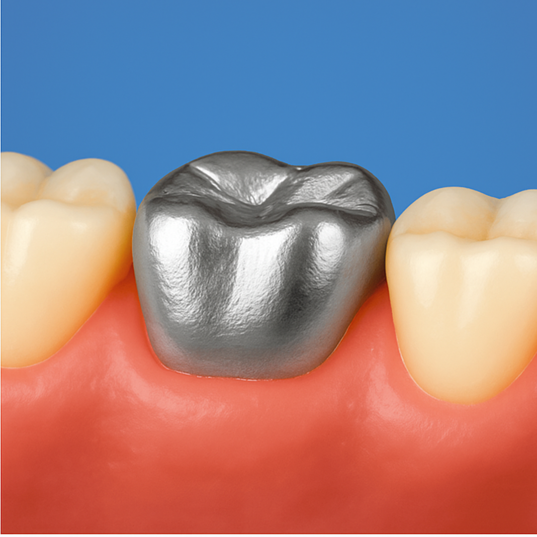 Metal Crown – Dental Crowns and Bridges Metal Crown – Dental Crowns and Bridges