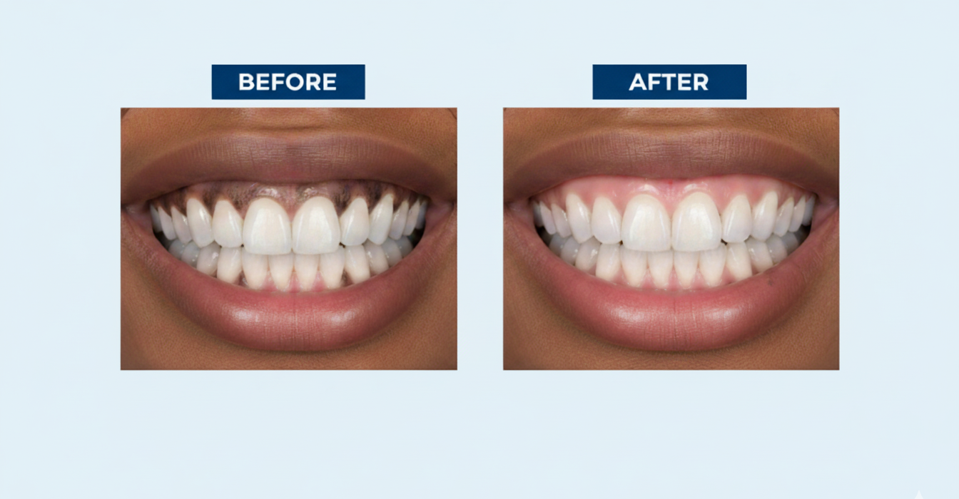 Gum Depigmentation-cosmetic-treatments Gum Depigmentation-cosmetic-treatments