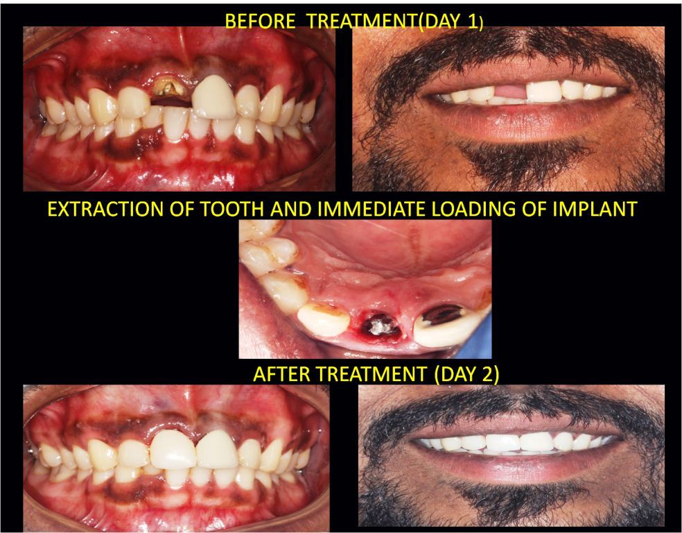 Immediate Dental Implant after extraction