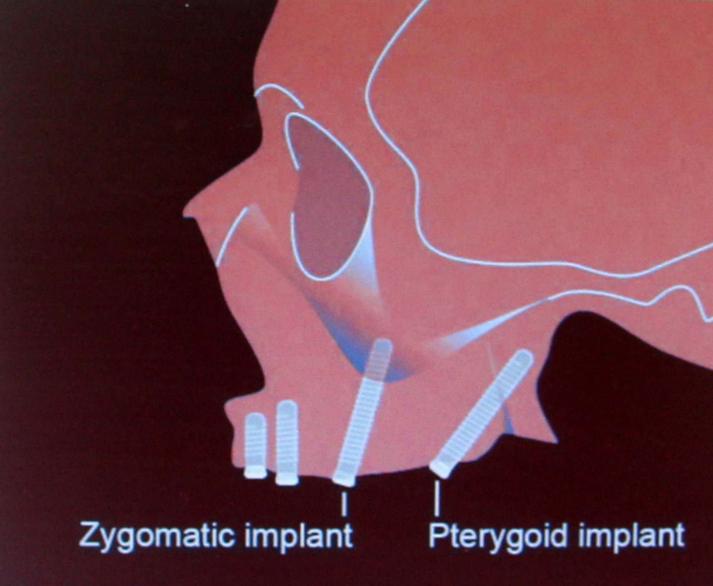 Pterygoid implants