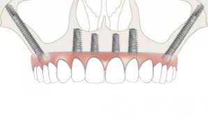 Tubero Pterygoid Implants