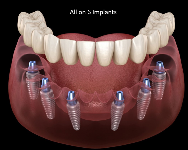 all-on-6-dental-implants