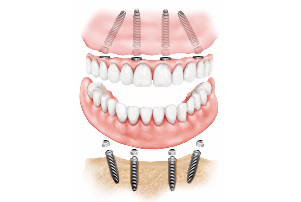 all-on4-dental-implant
