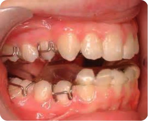 myofunctional appliance