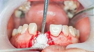 bone-grafting