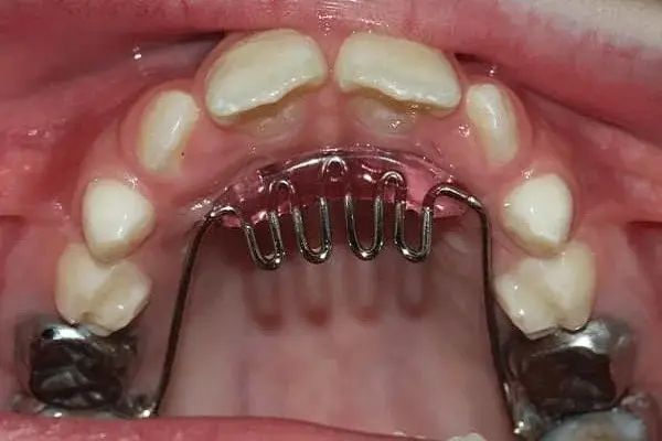 Habit breaking appliance