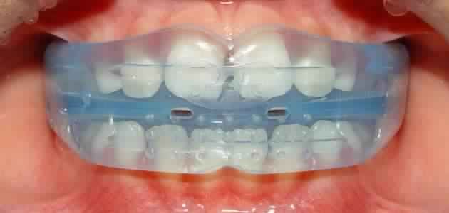 habit-breaking-appliance<br />
