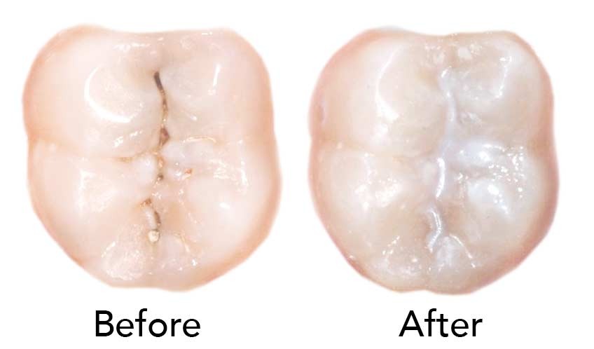 pit and fissure sealant